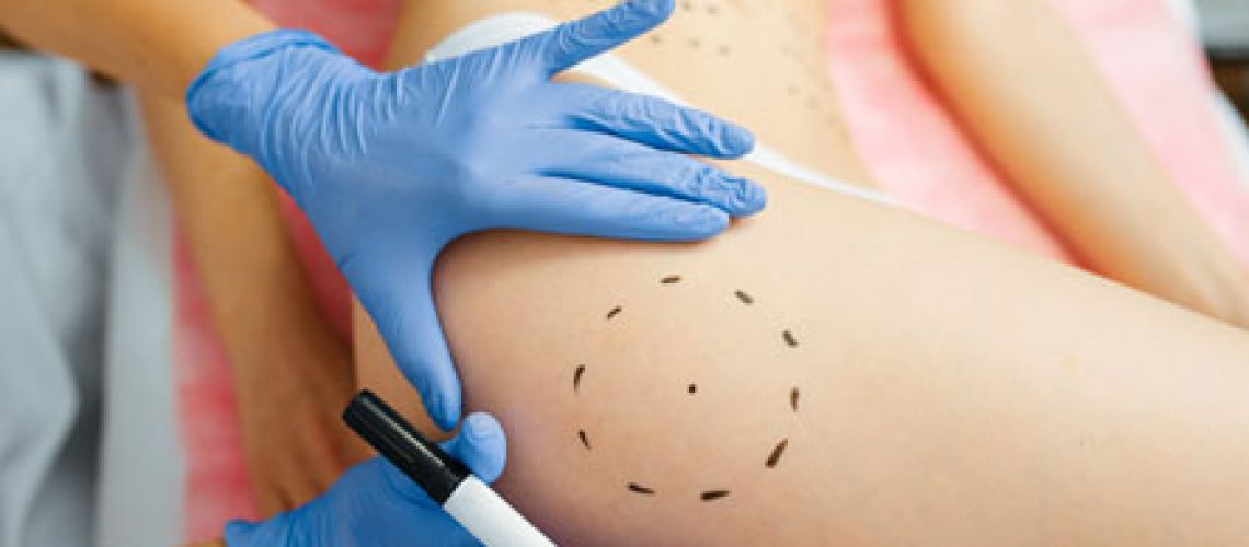 cosmetician-with-marker-puts-dotted-lines-on-body-46BU9A4.jpg